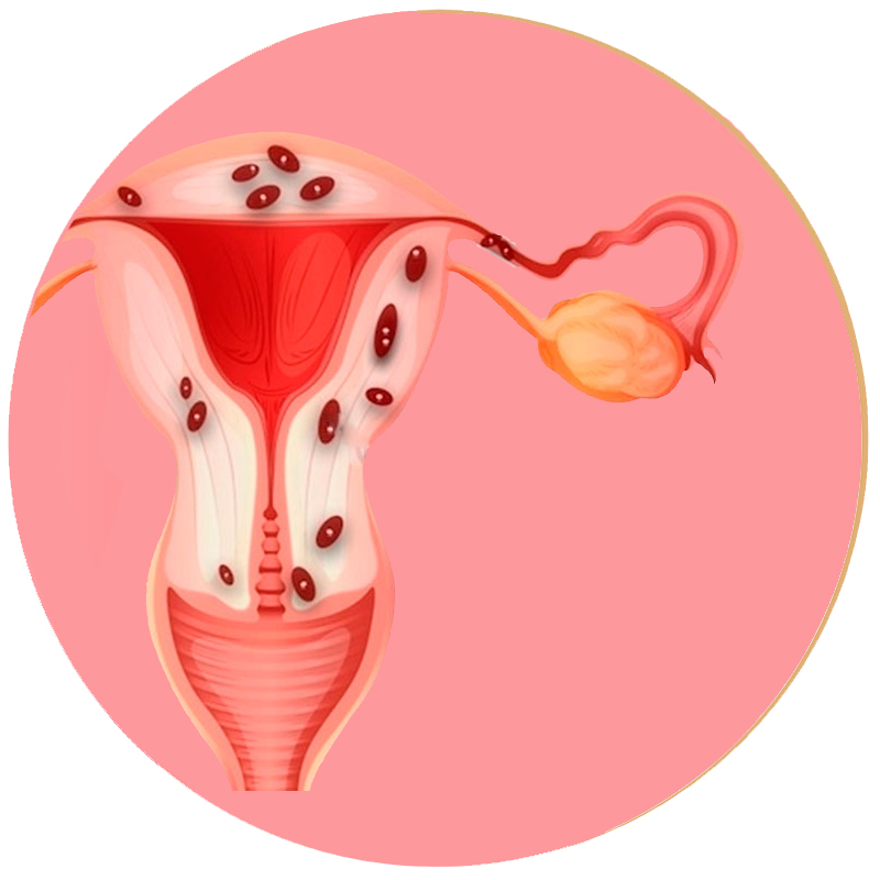 Sinto cólicas menstruais intensas. Pode ser Endometriose? - Clínica Rubens  do Val CRM 58764