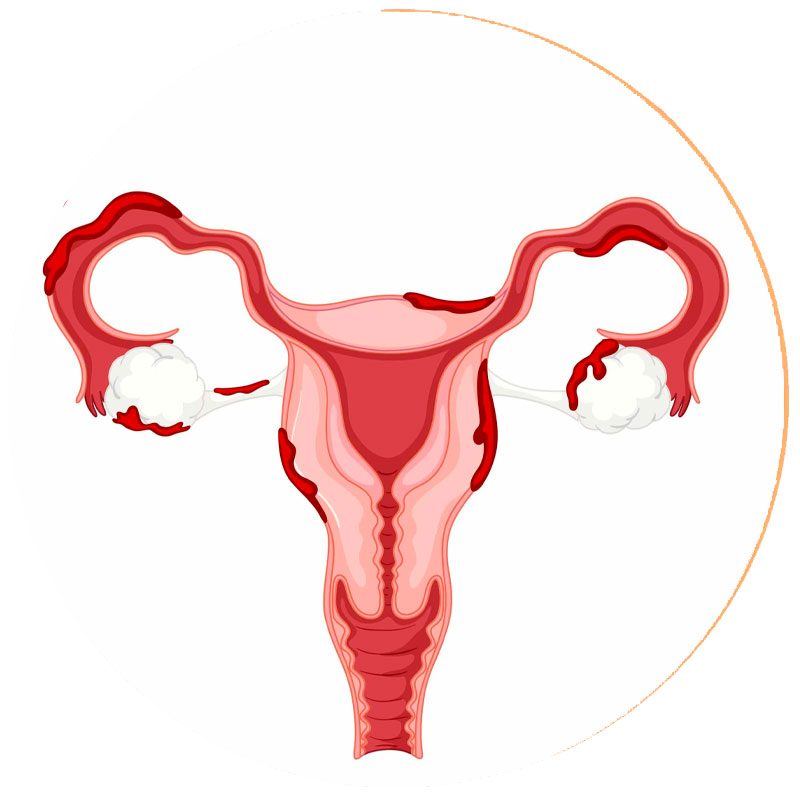 Endometriose | Clínica Rubens do Val CRM 58764