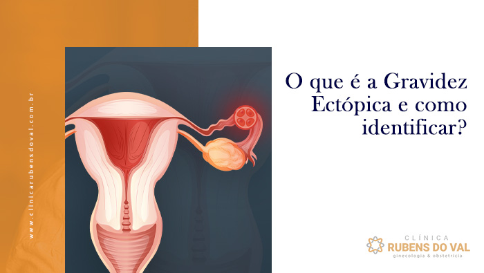 Resumo sobre gravidez ectópica