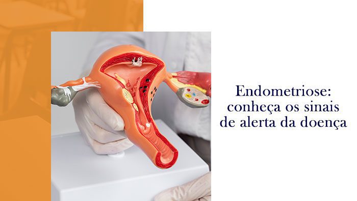 Endometriose conheca os sinais de alerta da doenca blog