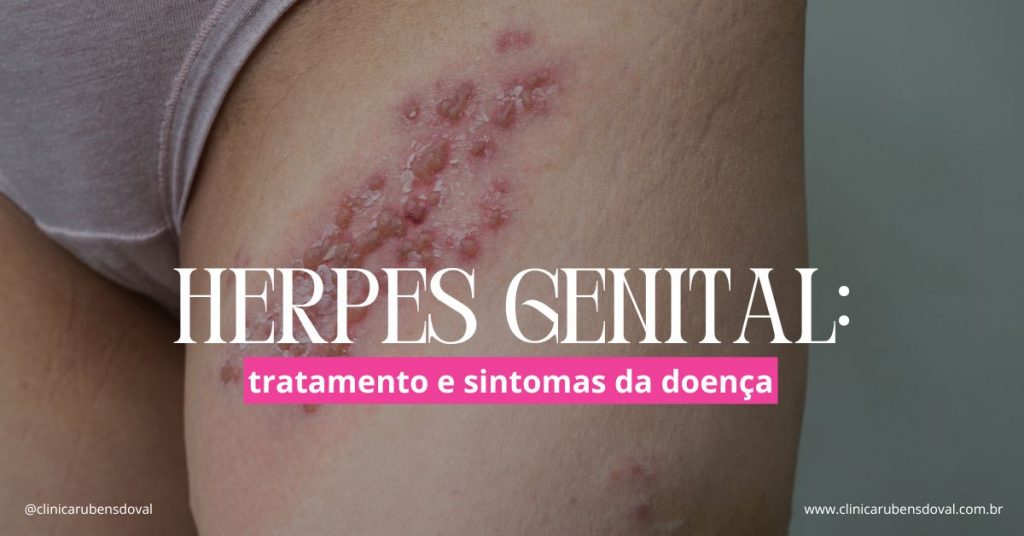 Lesão avermelhada com bolhas agrupadas na pele, característica de infecção por herpes genital na região da virilha.