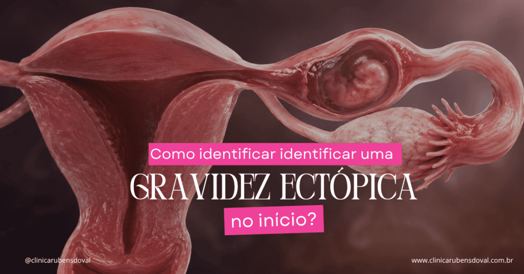 Como identificar uma gravidez ectópica no início? 1 Ilustração anatômica do útero, ovário e trompa uterina, com estrutura embrionária localizada no interior da trompa.