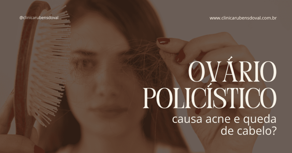 Ovário policístico causa acne e queda de cabelo? 1 Arte sobre ovário policístico, acne e queda de cabelo